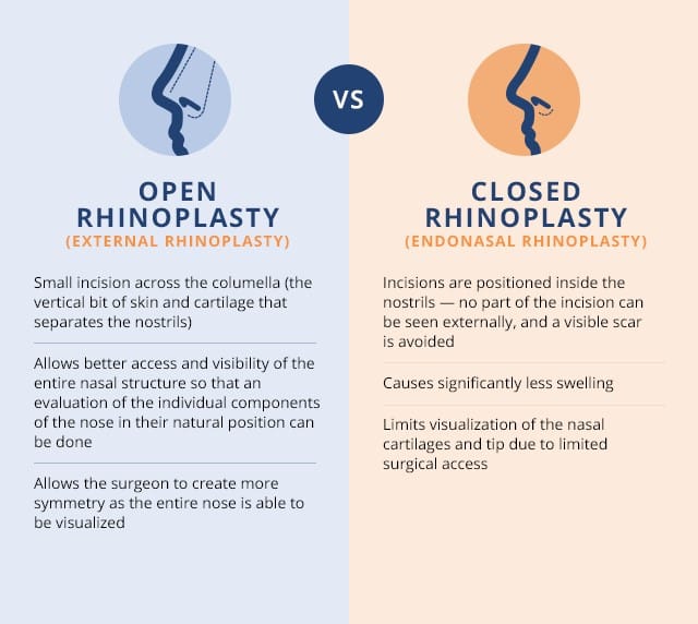 Diagram showing Open Rhinoplasty vs. Closed Rhinoplasty