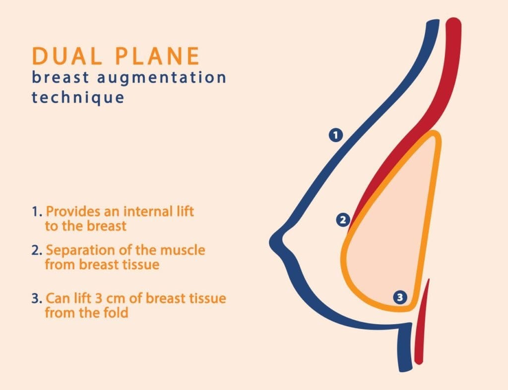 Dual Plane Breast Augmentation Technique diagram