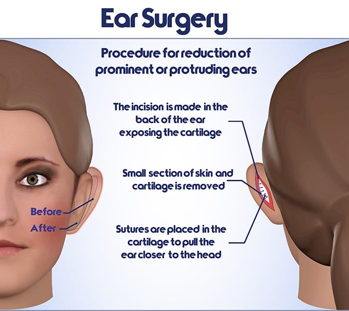 Ear Surgery Diagram