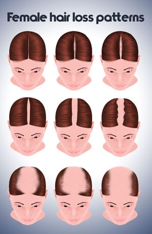 Female hair loss patterns diagram