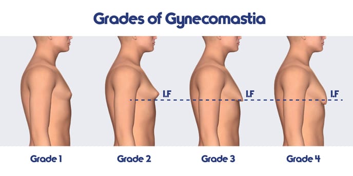 Grades of Gynecomastia Diagram