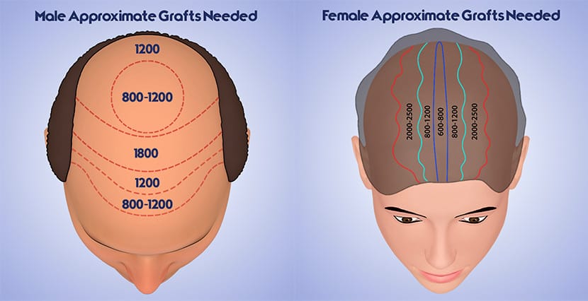 Hair Restoration Diagram