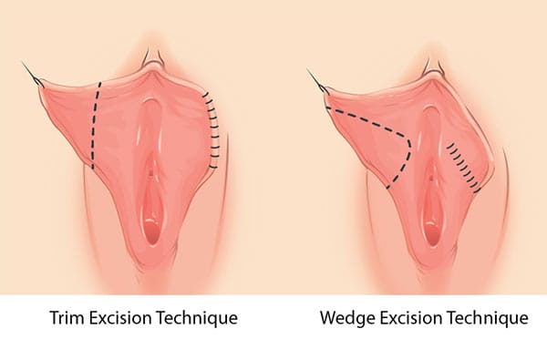 Diagram of Trim Excision Technique versus Wedge Excision Technique