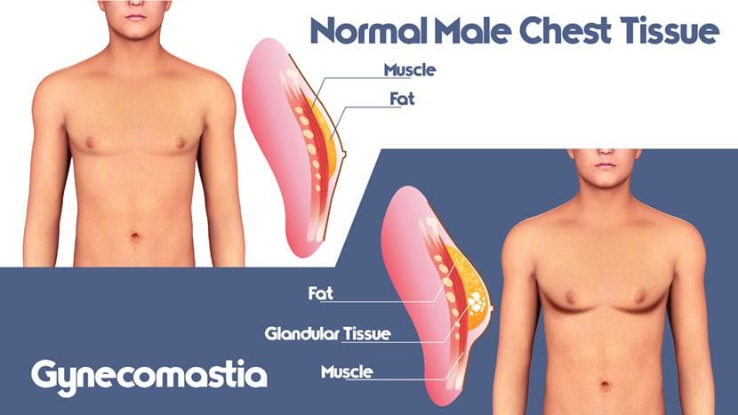 Diagram of gynecomastia