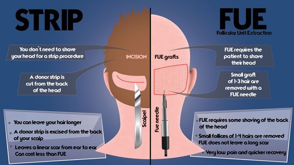 Comparison diagram between strip hair transplant procedure and follecular unit extraction