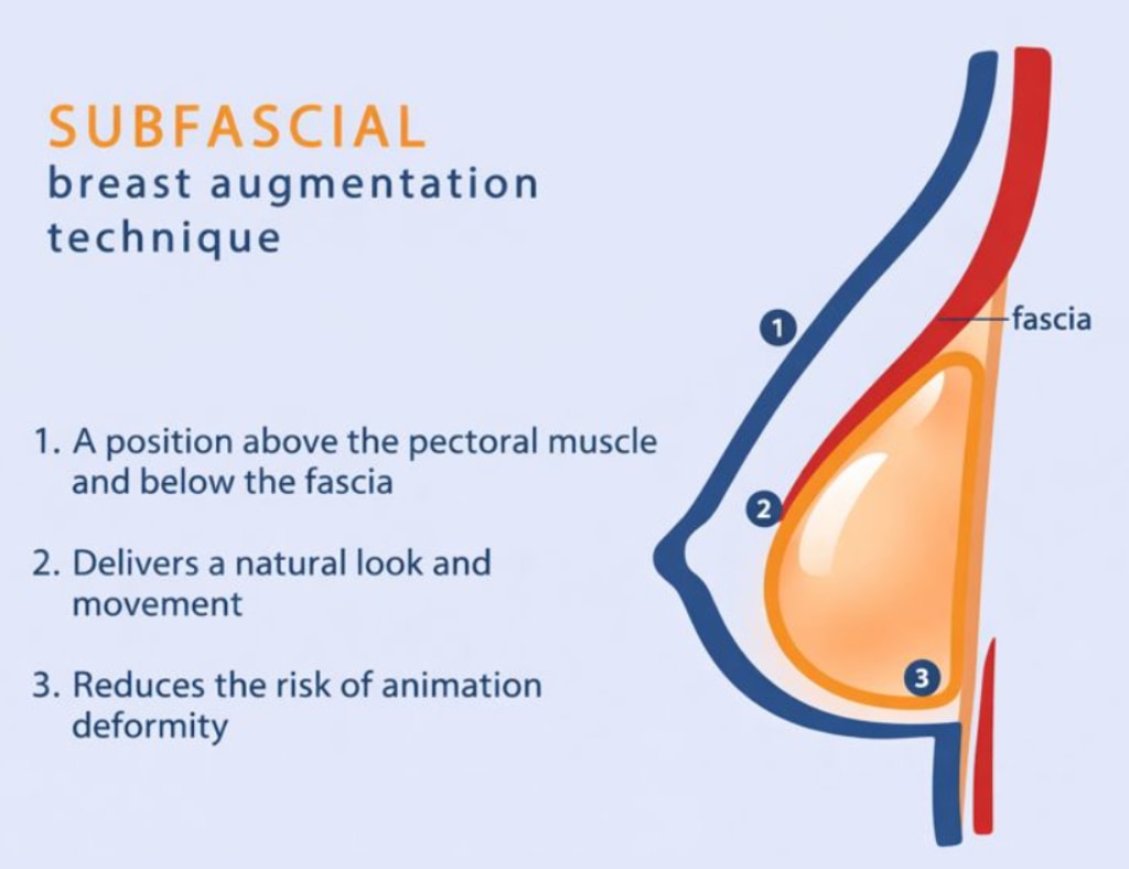 Subfacial Breast Augmentation Technique diagram