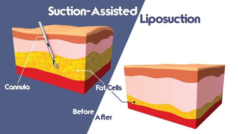 Suction-assisted liposuction procedure diagram
