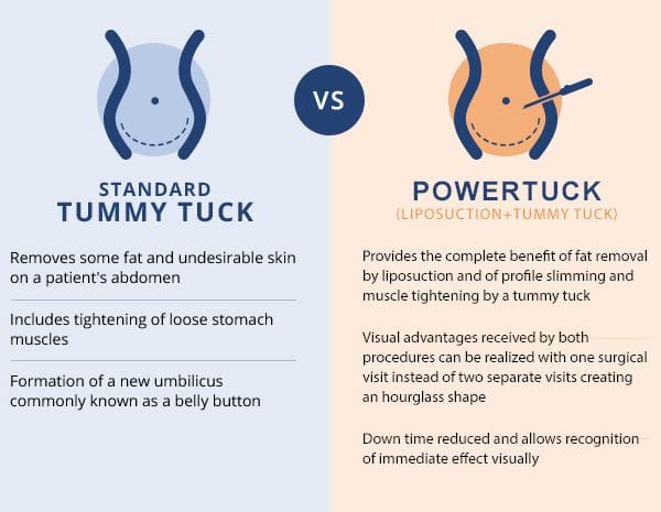 Standard Tummy Tuck versus Power Tuck comparison diagram