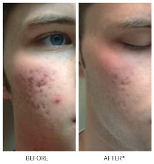 Before and After of microneedling process for acne