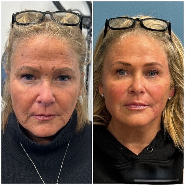 Before and After Liquid Facelift Photos