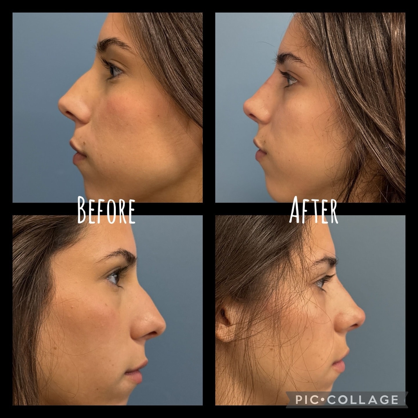 Before and after photos of liquid rhinoplasty
