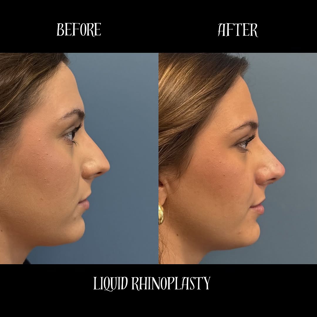 Before and after photos of liquid rhinoplasty