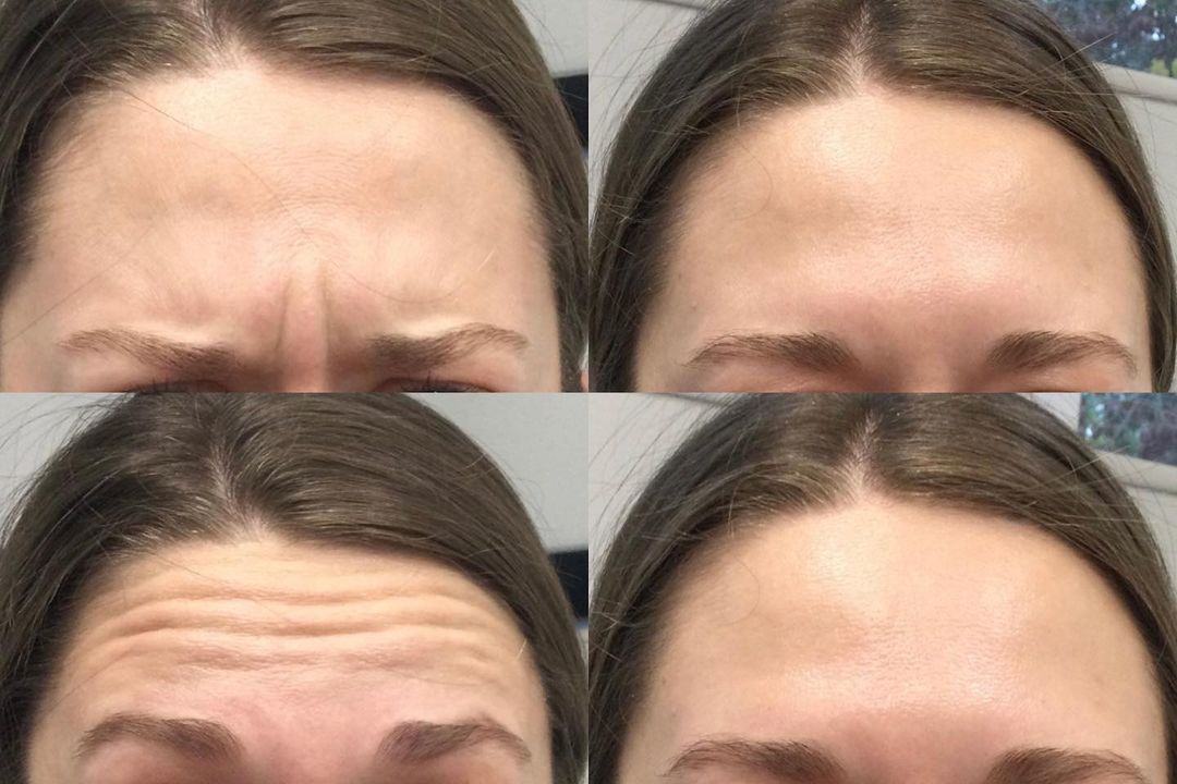 Botox before and after photos