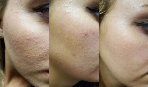 Chemical peel before and after photos