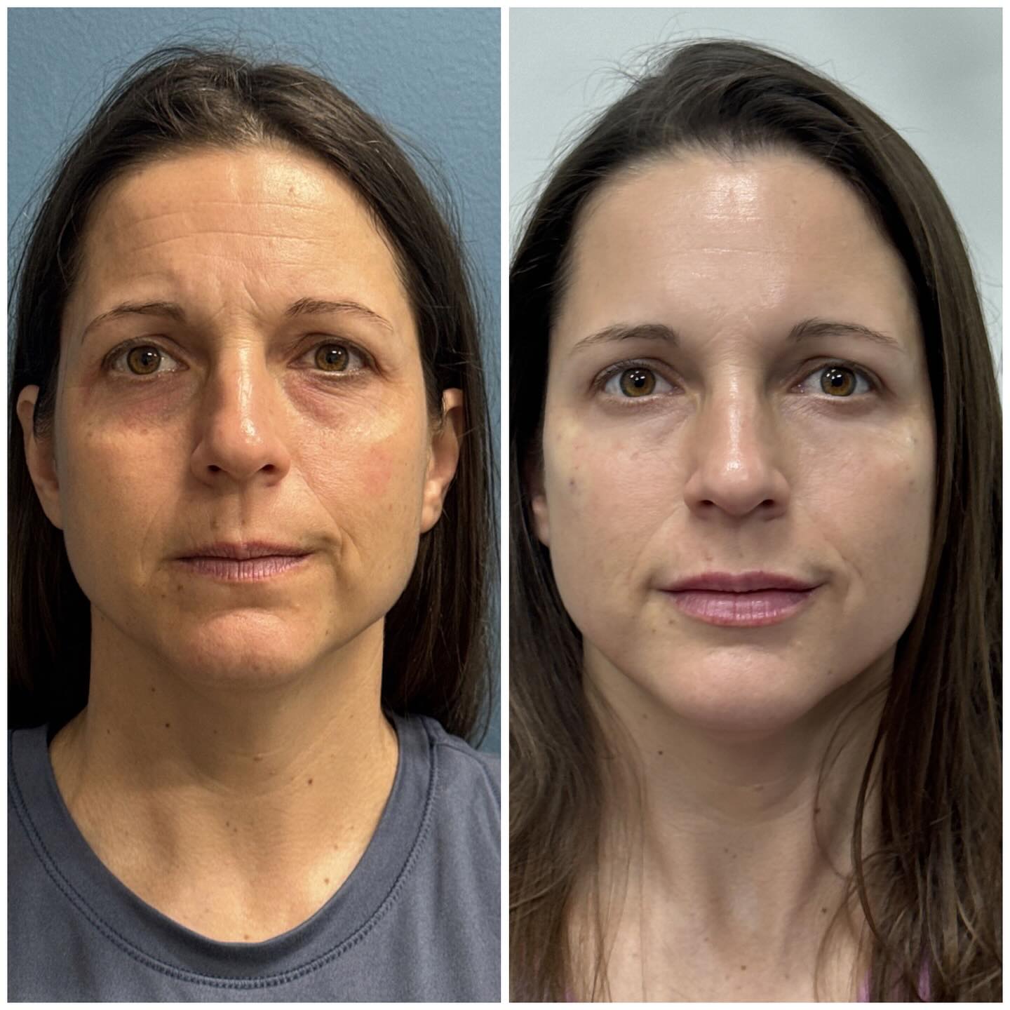 Before and After photos of patient treated with dermal fillers