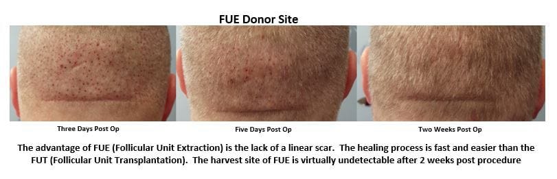 FUE Donor Site