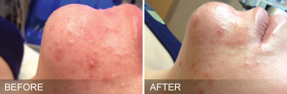Before and After Photos of HydraFacial