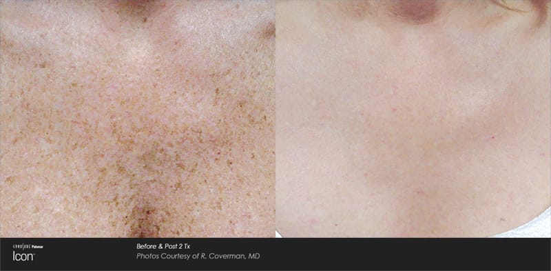 Photofacial before and after of chest