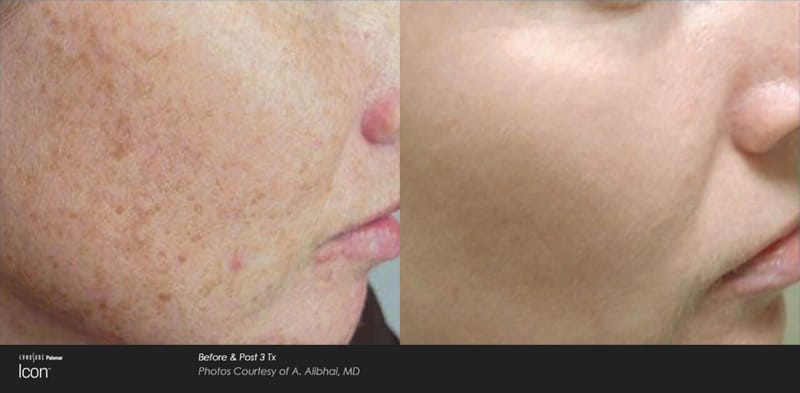 Photofacial before and after of face