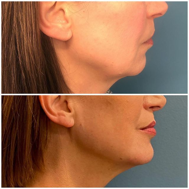 Before and after photos of Juvederm treatment for jawline