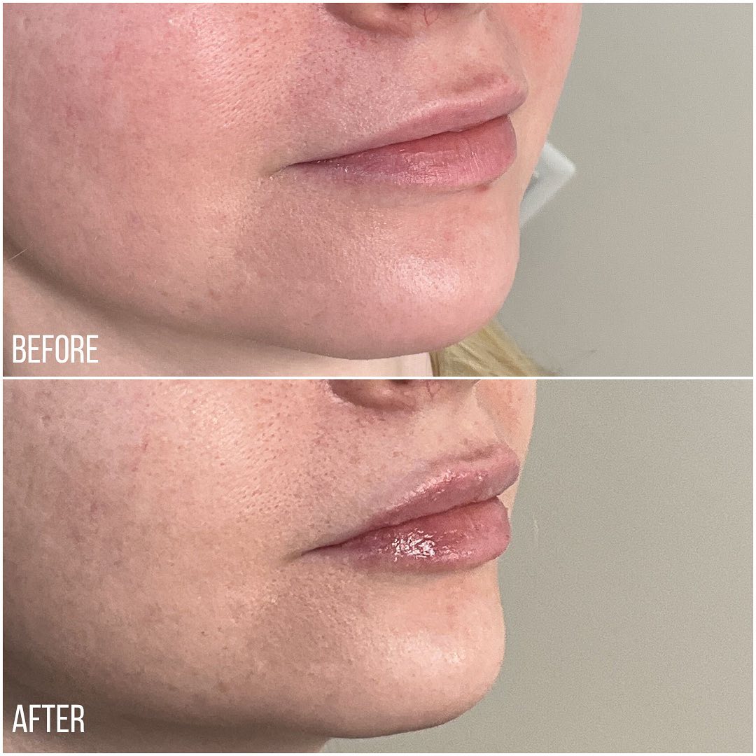 Before and after photos of Juvederm treatment for lips
