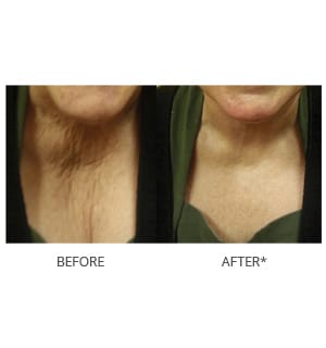 Microneedling before and after photos