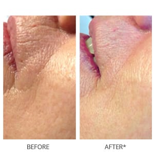 Microneedling before and after photos
