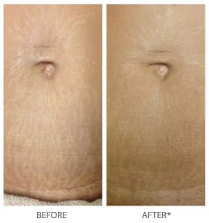 Microneedling before and after photos