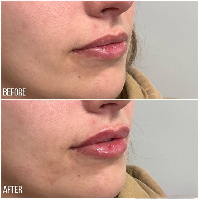 Before and After Photos of Restylane treatment