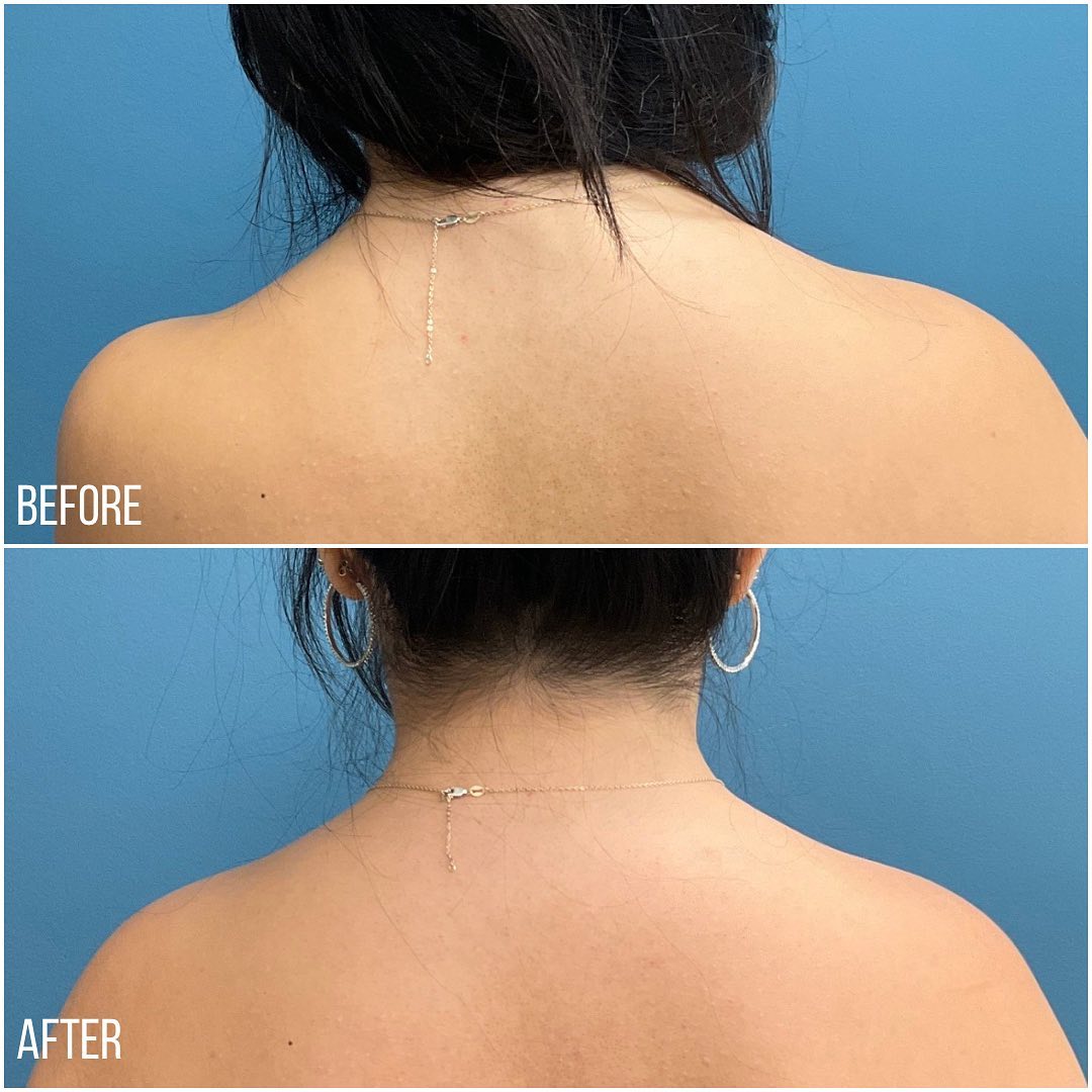 TrapTox before and after photos